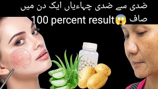 chaiyon ka ilaj permanently pigmentation treatment at home full real remedy plzz try [upl. by Ellga]