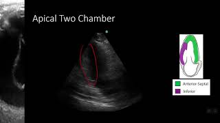 PointofCare Echo Regional Wall Motion Abnormalities [upl. by Jessey]