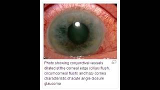 ClosedNarrow Angle Glaucoma  Chronic Closure amp Acute Closure [upl. by Nirej]