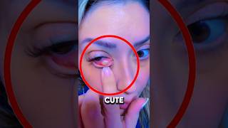 Pimple On Eye 👀 pimplepopping pimplepopper pimpleremoval pimplepop [upl. by Obadias]