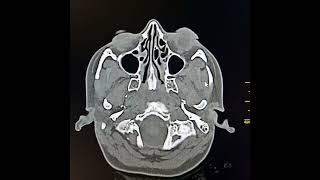 Otitis media and acute mastoiditis [upl. by Nolrac]