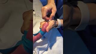 INFANT BABY IV LINE INSRATION 🩺health ivfluids injection youtubeshorts [upl. by Nosreip653]