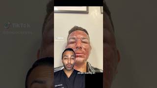 Is Getting An Extreme Chemical Peel Worth It Dr Somji Explains [upl. by Aiuqat122]