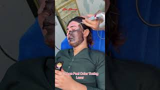 Carbon Peel Laser Treatment getsmarthairclub viralvideo laserhairremoval [upl. by Alrep566]