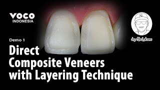 Direct Composite Veneers with Layering Technique using AMARIS  Operative Dentistry  VOCO GmbH [upl. by Lohner916]