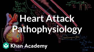 Heart attack myocardial infarction pathophysiology  NCLEXRN  Khan Academy [upl. by Clint]