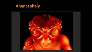 Forebrain Anomalies  Anencephaly amp Holoprosencephaly [upl. by Lalaj248]