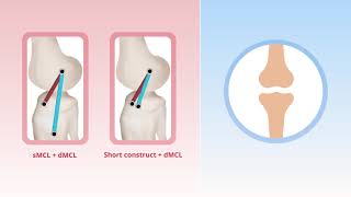 Alternative Medial Collateral Ligament Reconstruction Techniques [upl. by Niliram]