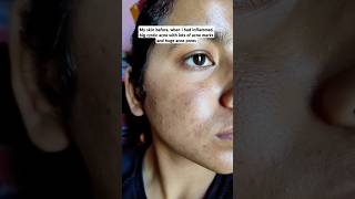 Using adapalene amp benzoyl peroxide gel in acne prone skin skin peel adapalenebenzoylperoxideacne [upl. by Philbin680]