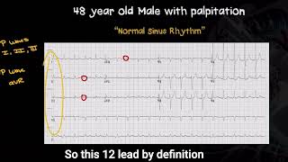 What defines a true normal sinus rhythm on a 12lead ECG [upl. by Sonitnatsnoc]