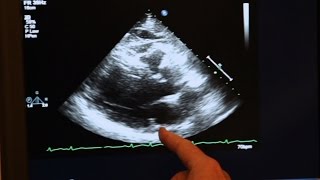 Echocardiogram Demonstration [upl. by Lemmor716]