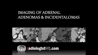 Imaging of Adrenal Adenomas amp Incidentalomas [upl. by Eiramnwad]