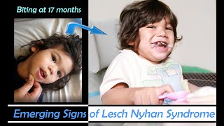 Early Emerging Signs of Lesch Nyhan Syndrome in DaveyBiting Started at 17 months [upl. by Aan]