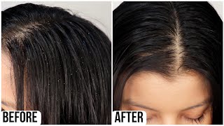 I Tried Anti Dandruff Kit For My Fungal Dandruff [upl. by Rupert254]