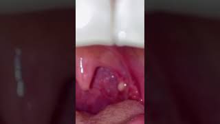 Tonsil Cyst Removal [upl. by Ellecrad]