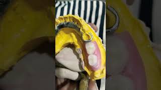 Lower Cost Partial Denture 😁😁😁rpddentalprocedure partialdenture costpartialdenture [upl. by Marcoux]