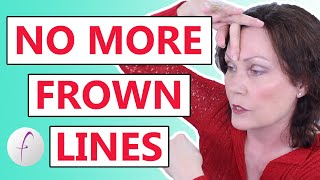 How to Remove Frown Lines Naturally [upl. by Oam]