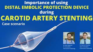 Importance of using distal embolic protection device during carotid artery stenting [upl. by Wilona102]