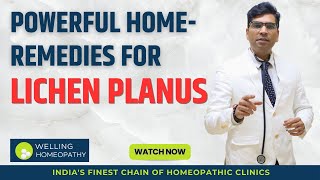 Powerful Home Remedies For Lichen Planus [upl. by Eilojne]