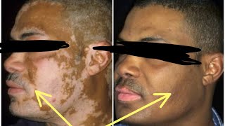 VITILIGO EXPLAINED causes of vitiligo treatment for vitiligo vitiligo skin disease treatment [upl. by Press935]