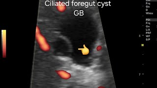 Ciliated foregut cyst of gallbladder very rare case ultrasound amp color Doppler overview [upl. by Oruhtra]