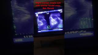 Right overian simple cyst with uterine fundal mass ultrasound ultrasoundimages humanhealthandd [upl. by Aisor]