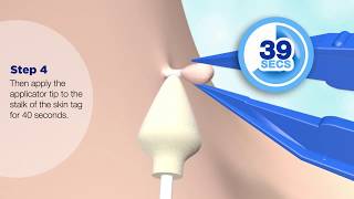 Remove skin tags in one treatment  Cryotag Skin Tag Remover  Up to 12 Treatments [upl. by Dachy]