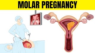 Molar Pregnancy Hydatidiform Mole  Types Causes Signs amp Symptoms Diagnosis And Treatment [upl. by Luana]