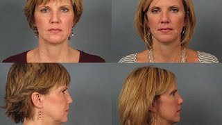 Mini Facelift and More Video Indianapolis Indiana  3178480001  Dr Janet Turkle [upl. by Capp]