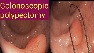 Colonoscopic polypectomy l l Endo Cut [upl. by Chader]