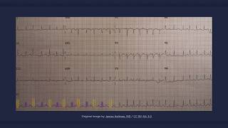 Electrical Alternans ECG [upl. by Weeks]