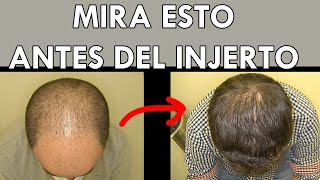 Injerto de pelo sin rasurar antes y después  Técnica FUE [upl. by Wons]