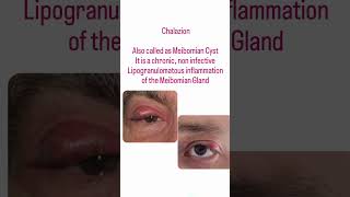 Chalazion  eyelid shorts ytshorts education nainaeyecare❤❤ [upl. by Lacim747]