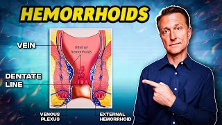 The 1 Best Remedy for Hemorrhoids  Dr Berg [upl. by Hpeosj240]