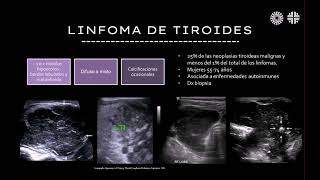 Radiología en 5 minutos Linfoma de tiroides [upl. by Afinom]