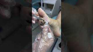 Treatment Callus and Dead skin Ep23  Sheng Clinic [upl. by Dazhehs]