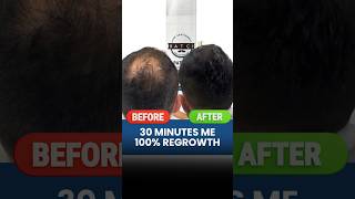 30 Minutes Me 100 Hair Regrowth  Hair Loss  Hair Tips  Hair Expert  Adon Hair Care [upl. by Eihcra546]