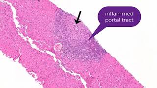 Histology of Primary Biliary Cholangitis [upl. by Haik489]