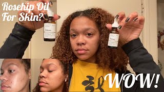 I Tried Rosehip Seed Oil On My Face For 30 Days  The Ordinary  Hyperpigmentation [upl. by Bowen214]