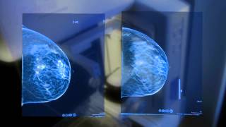 3D Mammography [upl. by Ahsieka]