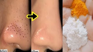 How to remove blackheads from nose  Nose blackhead removal  Remove blackheads from nose at home [upl. by Kinzer153]