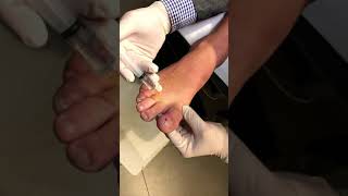 How to Perform a HBlock to Numb a Toe with Local Anaesthetic for Ingrown Nails [upl. by Kappenne]