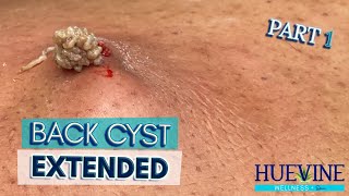 Part 13 Massive Back Cyst Extended  HueVine [upl. by Hsac313]