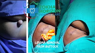 lipoma removal from buttock  dr bijay  tokha horizon  😱😱😱😱 [upl. by Nicoline597]