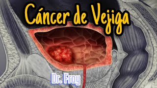 💀CÁNCER DE VEJÍGA💦Epidemilogía📚Factores de Riesgo⚠️Diagnóstico🔬Tratamiento⚕️Dr Froy🩺 [upl. by Moncear]