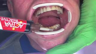 Activa Splinting of loose lower front teeth quick and cost effective [upl. by Aciretnahs113]