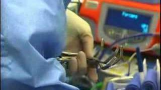 Laparoscopic Nephrectomy [upl. by Can]