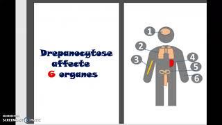 Drépanocytose Anémie falciforme enfant Causes symptômes traitement génétique dépistage 3 minutes [upl. by Nnaer758]