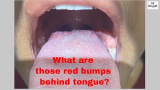 What are Red bumps behind Tongue  Taste Buds How to keep them clean and healthy [upl. by Minne]