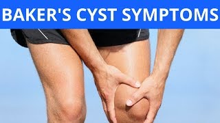 Bakers Cyst Symptoms [upl. by Ahsienek]